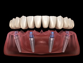 Digital image of implant denture