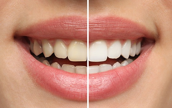 a before/after image of a patient’s smile